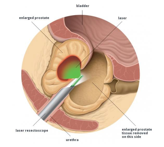 prostata ingrossata medicinali