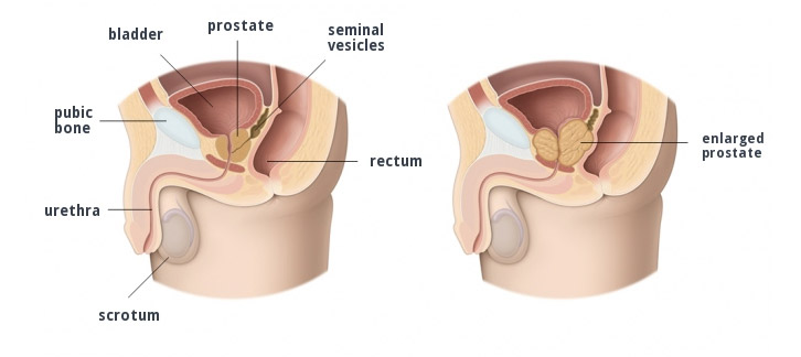 dimensioni prostata in ml